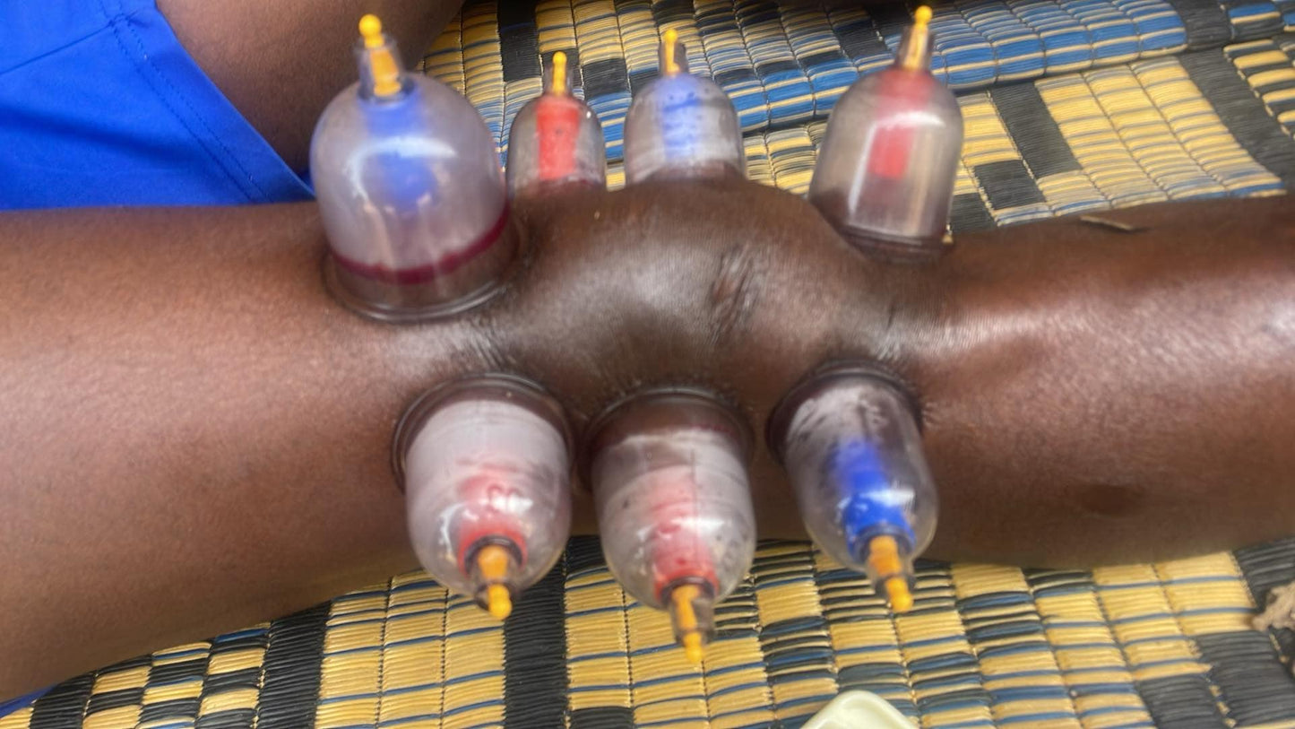 Knee Pain Hijama Therapy