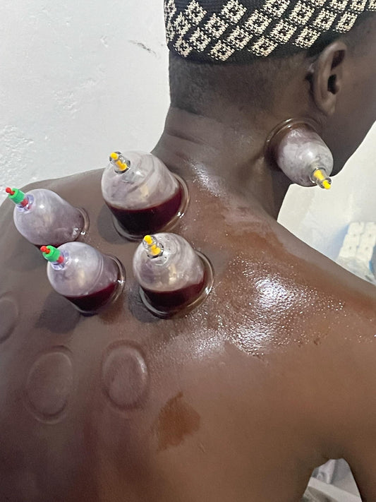 Neck & Shoulder Pain Hijama Therapy